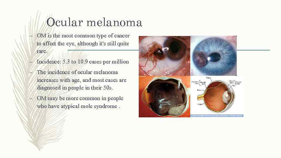 Ocular melanoma – OM is the most common type of cancer to affect the