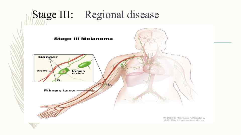 Stage III: Regional disease 