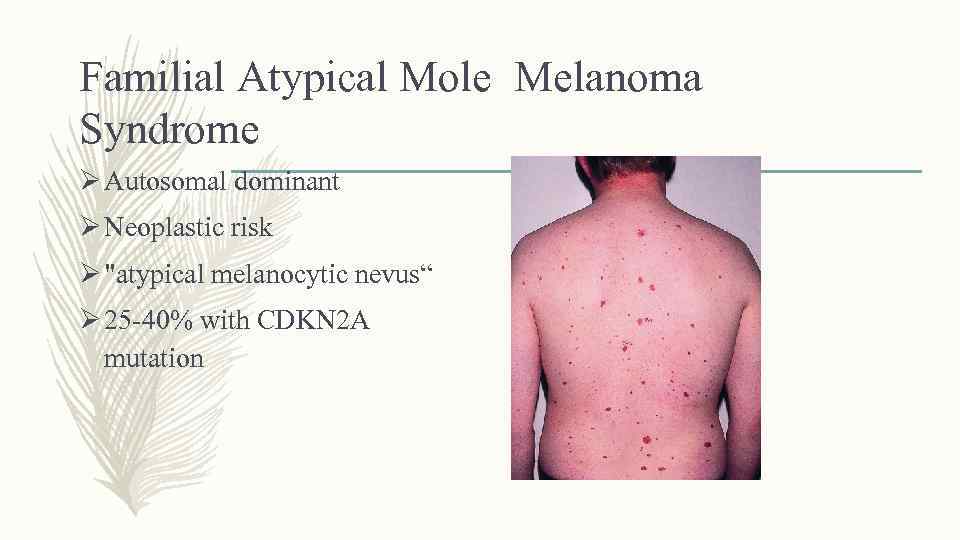Familial Atypical Mole Melanoma Syndrome Ø Autosomal dominant Ø Neoplastic risk Ø 