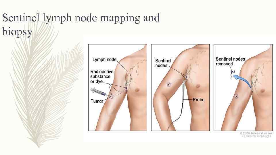 Sentinel lymph node mapping and biopsy 