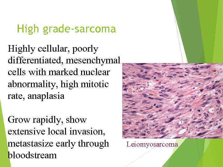 High grade-sarcoma Highly cellular, poorly differentiated, mesenchymal cells with marked nuclear abnormality, high mitotic