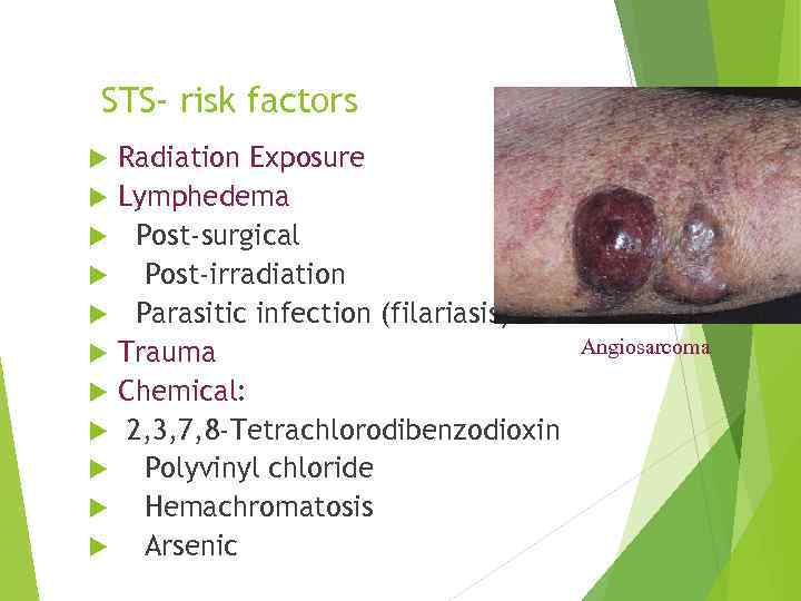 STS- risk factors Radiation Exposure Lymphedema Post-surgical Post-irradiation Parasitic infection (filariasis) Trauma Chemical: 2,