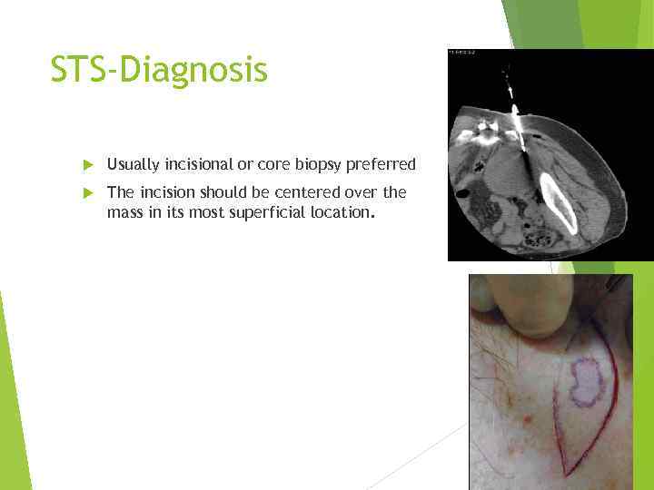 STS-Diagnosis Usually incisional or core biopsy preferred The incision should be centered over the