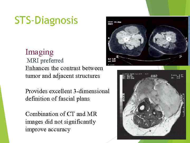 STS-Diagnosis Imaging MRI preferred Enhances the contrast between tumor and adjacent structures Provides excellent