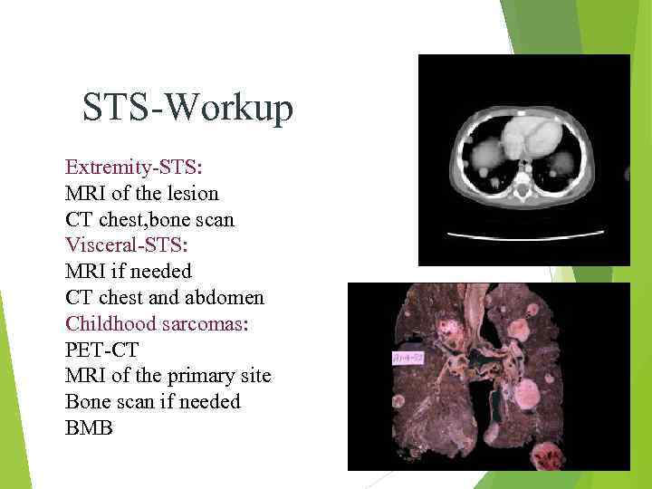 STS-Workup Extremity-STS: MRI of the lesion CT chest, bone scan Visceral-STS: MRI if needed