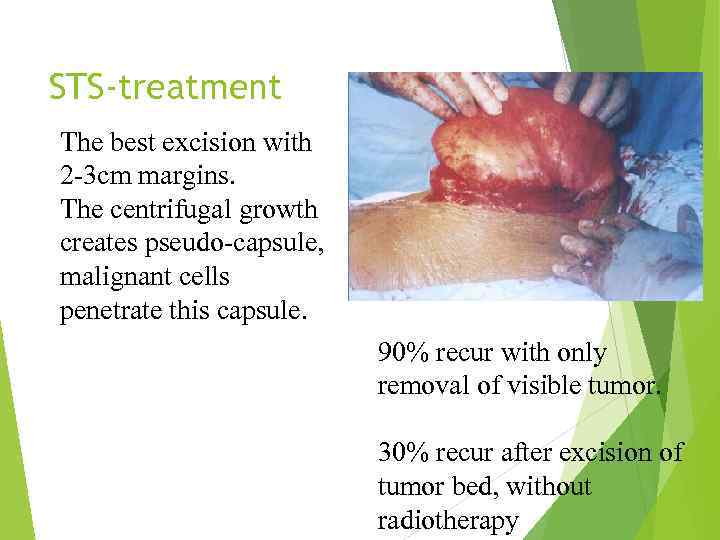 STS-treatment The best excision with 2 -3 cm margins. The centrifugal growth creates pseudo-capsule,