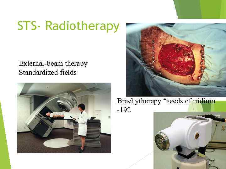 STS- Radiotherapy External-beam therapy Standardized fields Brachytherapy “seeds of iridium -192 