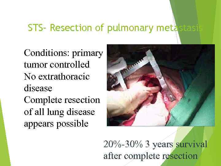 STS- Resection of pulmonary metastasis Conditions: primary tumor controlled No extrathoracic disease Complete resection