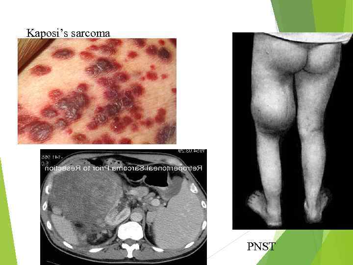 Kaposi’s sarcoma PNST 