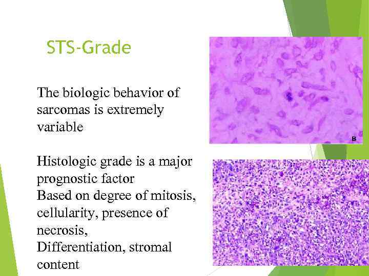 STS-Grade The biologic behavior of sarcomas is extremely variable Histologic grade is a major