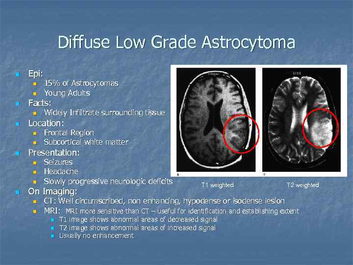 Diffuse Low Grade Astrocytoma n Epi: n n n Facts: n n n Frontal