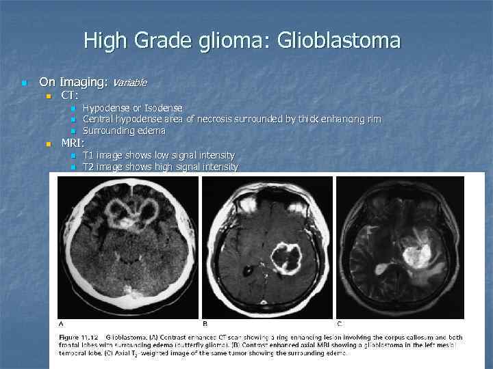 High Grade glioma: Glioblastoma n On Imaging: Variable n CT: n n Hypodense or