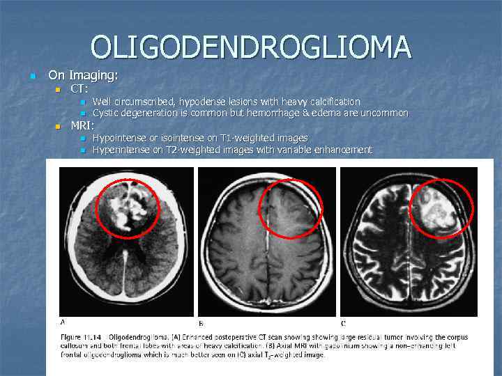 OLIGODENDROGLIOMA n On Imaging: n CT: n n n Well circumscribed, hypodense lesions with