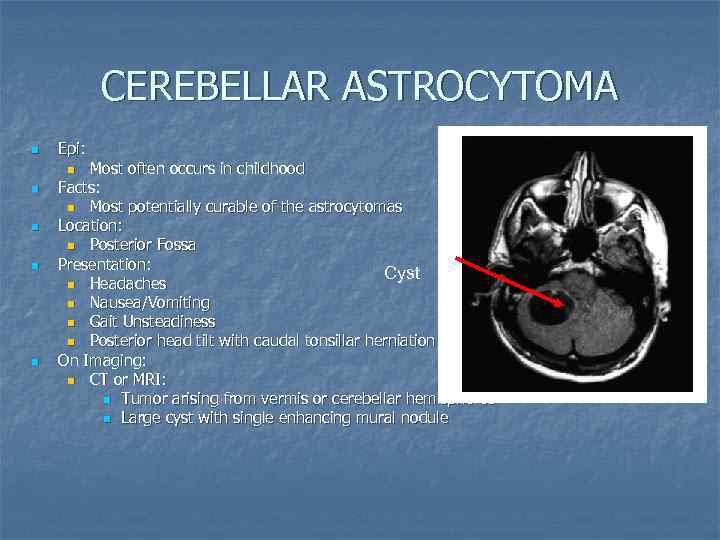 CEREBELLAR ASTROCYTOMA n Epi: Most often occurs in childhood Facts: n Most potentially curable