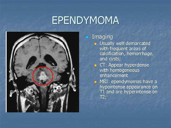 EPENDYMOMA n Imaging n n n Usually well demarcated with frequent areas of calcification,
