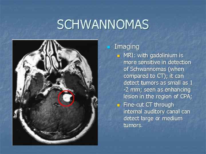 SCHWANNOMAS n Imaging n n MRI: with gadolinium is more sensitive in detection of