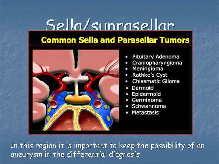 Sella/suprasellar In this region it is important to keep the possibility of an aneurysm