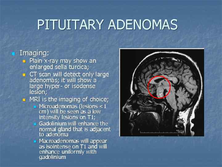 PITUITARY ADENOMAS n Imaging: n n n Plain x-ray may show an enlarged sella