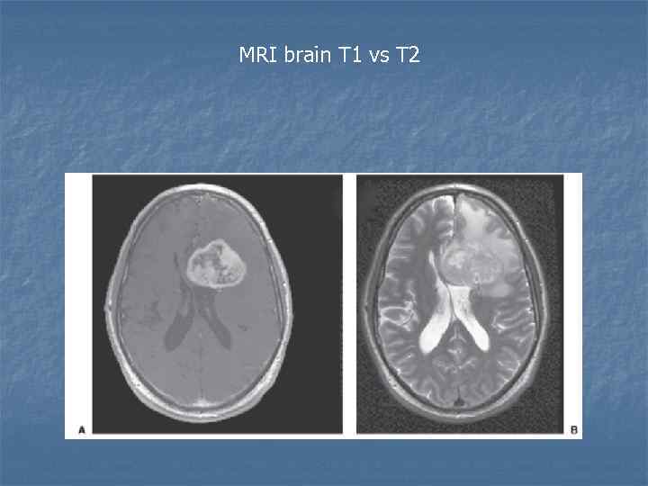 MRI brain T 1 vs T 2 