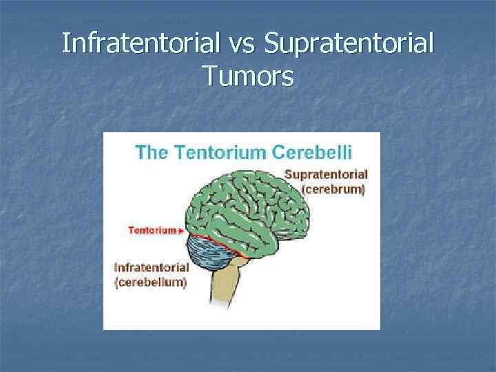 Infratentorial vs Supratentorial Tumors 