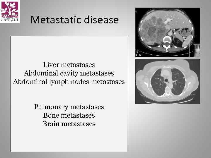 Metastatic disease Liver metastases Abdominal cavity metastases Abdominal lymph nodes metastases Pulmonary metastases Bone