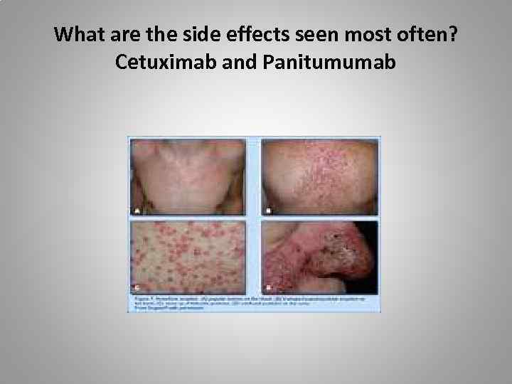 What are the side effects seen most often? Cetuximab and Panitumumab 