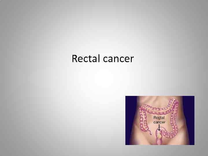 Rectal cancer 