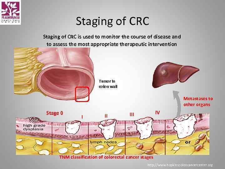 Current Treatment Strategies In Colorectal Cancer Valeriya Semenisty