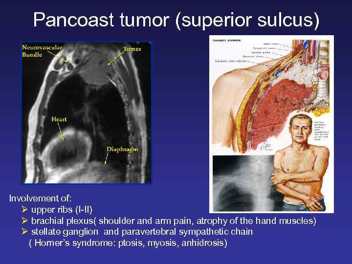 Pancoast tumor (superior sulcus) Involvement of: Ø upper ribs (I-II) Ø brachial plexus( shoulder