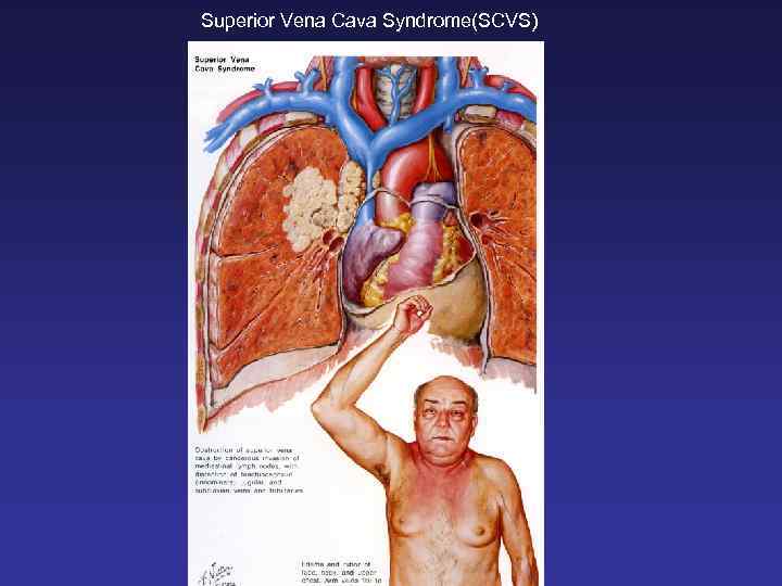 Superior Vena Cava Syndrome(SCVS) 