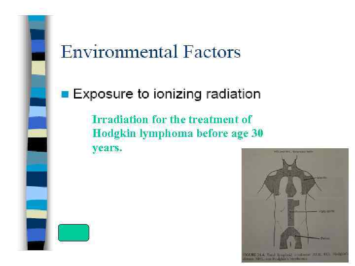 Irradiation for the treatment of Hodgkin lymphoma before age 30 years. 