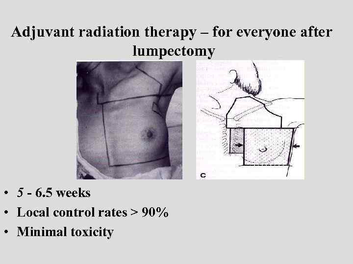 Adjuvant radiation therapy – for everyone after Adjuvantlumpectomy therapy: radiation • 5 - 6.