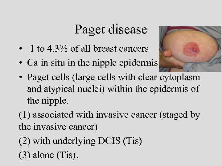 Paget disease • 1 to 4. 3% of all breast cancers • Ca in