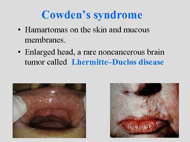 Cowden’s syndrome • Hamartomas on the skin and mucous membranes. • Enlarged head, a