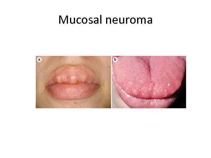 Mucosal neuroma 