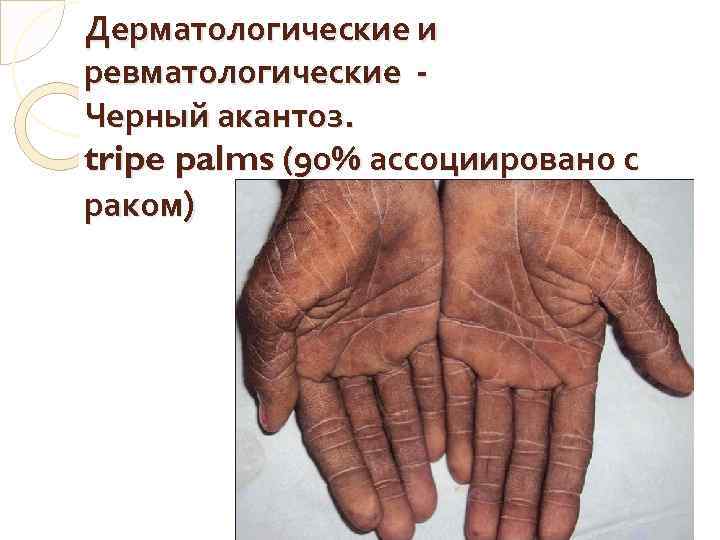 Дерматологические и ревматологические - Черный акантоз. tripe palms (90% ассоциировано с раком) 