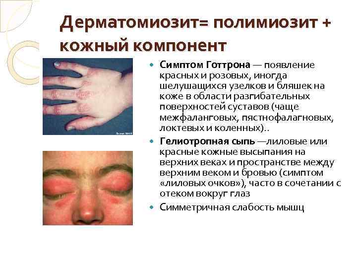 Дерматомиозит= полимиозит + кожный компонент Симптом Готтрона — появление красных и розовых, иногда шелушащихся