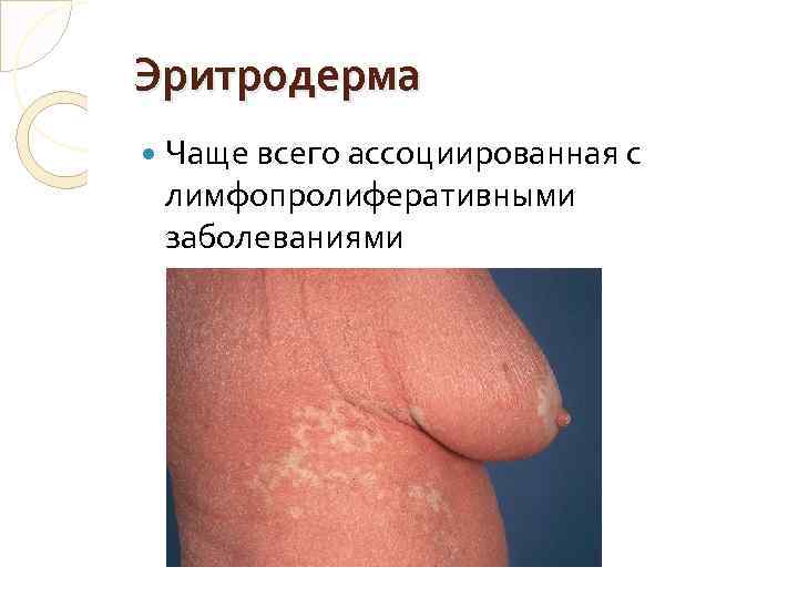 Эритродерма Чаще всего ассоциированная с лимфопролиферативными заболеваниями 