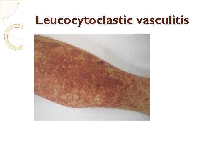 Leucocytoclastic vasculitis 