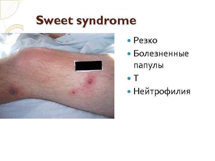 Sweet syndrome Резко Болезненные папулы Т Нейтрофилия 