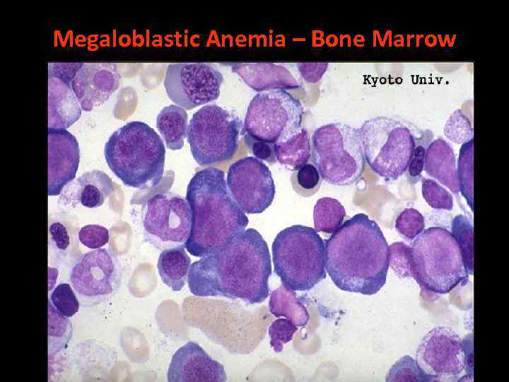 Megaloblastic Anemia – Bone Marrow 