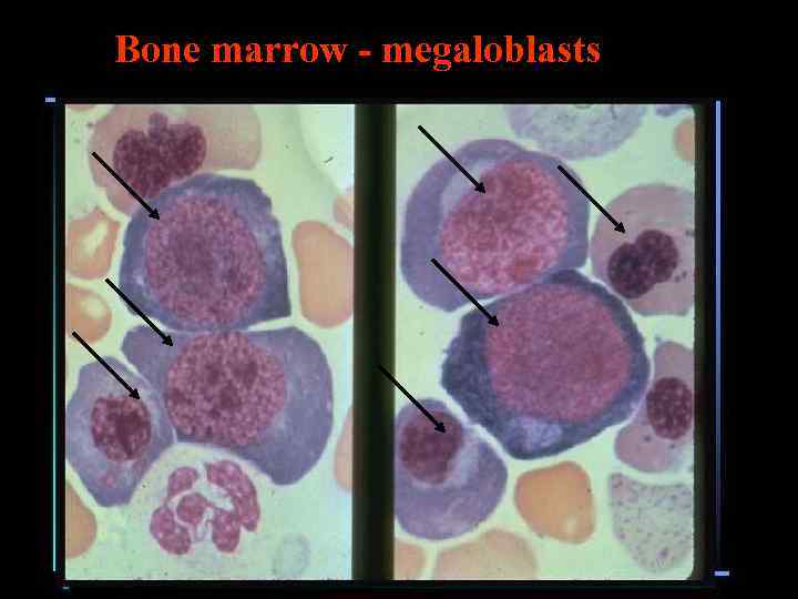 Bone marrow - megaloblasts 