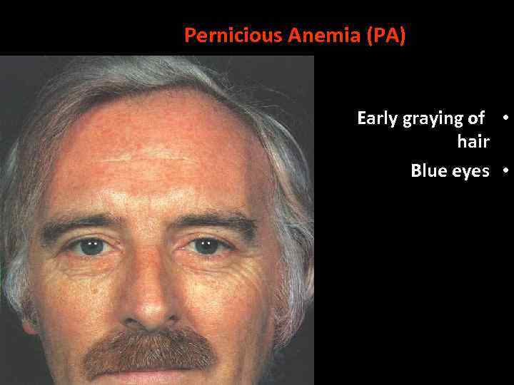 Pernicious Anemia (PA) Early graying of • hair Blue eyes • 