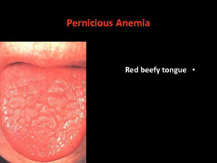Pernicious Anemia Red beefy tongue • 