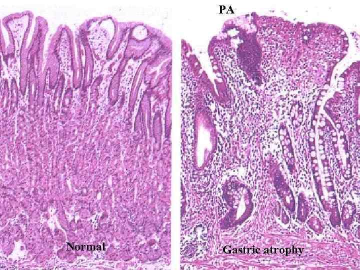PA Normal Gastric atrophy 