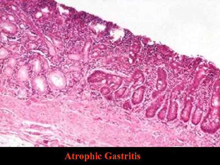 Atrophic Gastritis 
