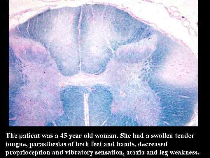 The patient was a 45 year old woman. She had a swollen tender tongue,