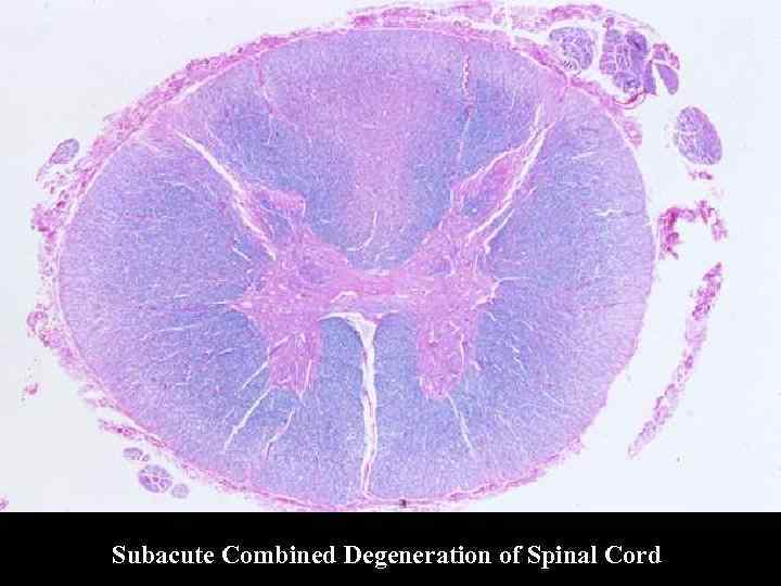 Subacute Combined Degeneration of Spinal Cord 