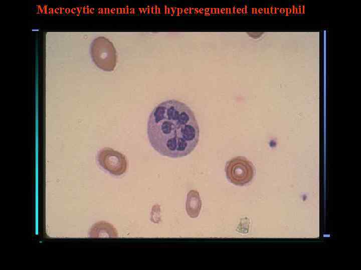 Macrocytic anemia with hypersegmented neutrophil 
