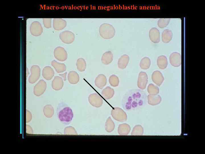Macro-ovalocyte in megaloblastic anemia 